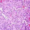 8A5 Astroblastoma, anaplastic vs GBM (Case 8) H&E 7.jpg