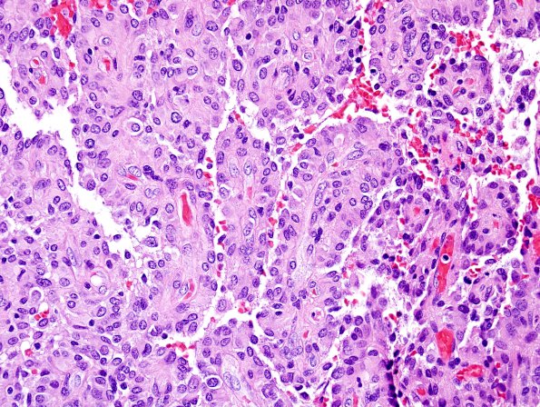 8A5 Astroblastoma, anaplastic vs GBM (Case 8) H&E 7.jpg