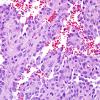 8A6 Astroblastoma, anaplastic vs GBM (Case 8) H&E 10.jpg