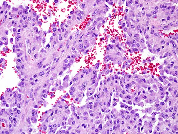 8A6 Astroblastoma, anaplastic vs GBM (Case 8) H&E 10.jpg