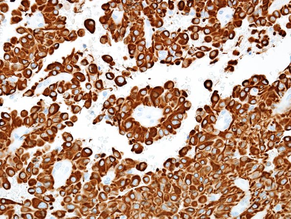 8B2 Astroblastoma, anaplastic vs GBM (Case 8) GFAP 11.jpg