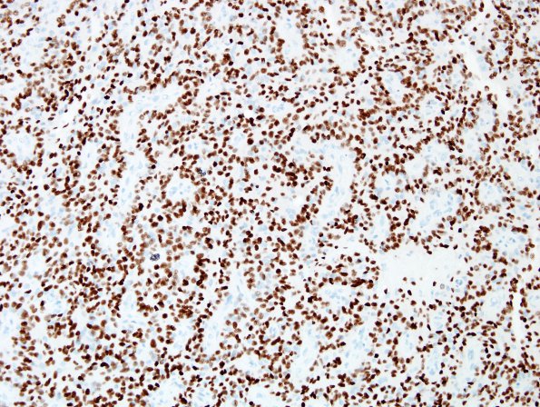 8C1 Astroblastoma, anaplastic vs GBM (Case 8) Olig2 2.jpg