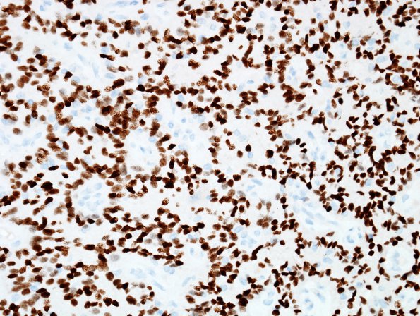 8C2 Astroblastoma, anaplastic vs GBM (Case 8) Olig2.jpg