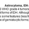 0A Astrocytoma, IDH-mutant, CNS WHO grade 4 - Text