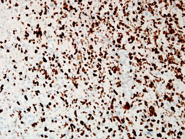 1D2 IDHmut Astro Gr4 (Case 1) area A p53 2.jpg