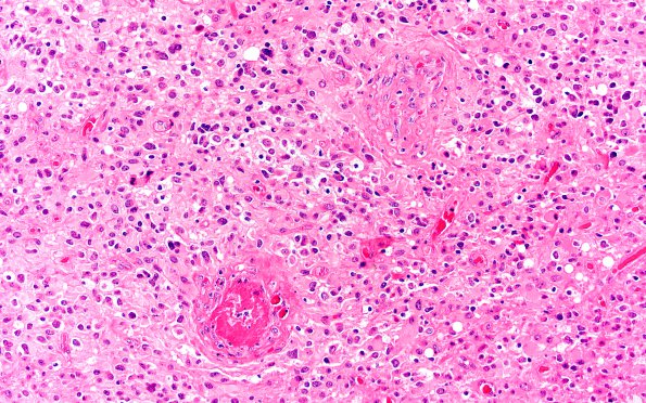 6A1 IDH mutant R132H (Case 6) H&E 1