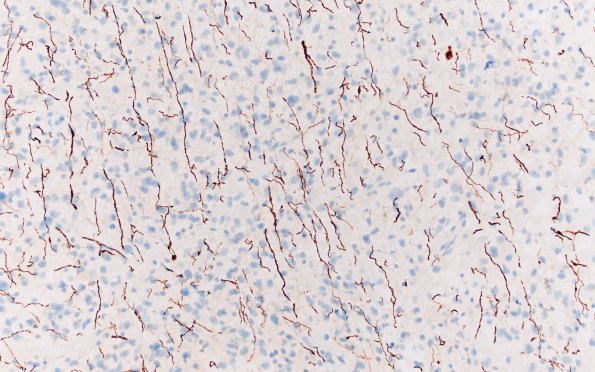 6D IDH mutant R132H (Case 6) NF 20X