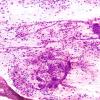 9A1 ( Case 9) H&E smear 1