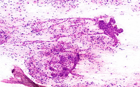 9A1 ( Case 9) H&E smear 1