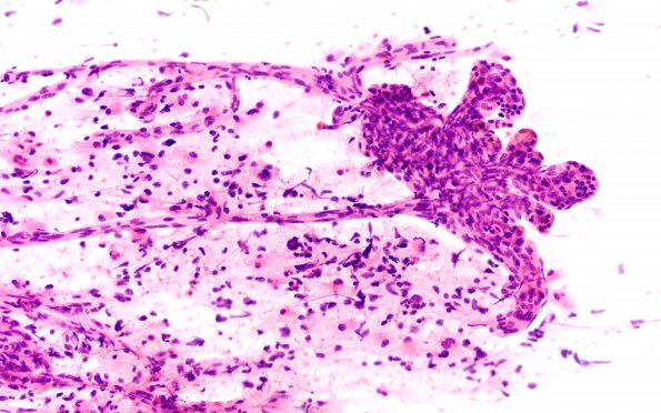 9A2 IDHmut Astro Gr4 (Case 9) H&E smear 3