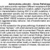 0A Astrocytoma, pilocytic, Gross Pathology - Text