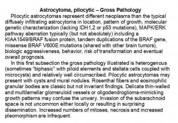 0A Astrocytoma, pilocytic, Gross Pathology - Text