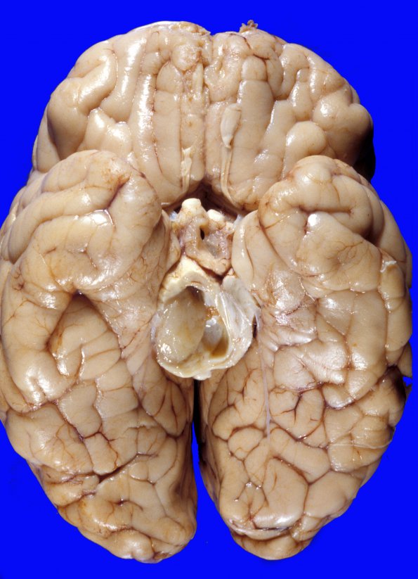 1A1 Astrocytoma, pilocytic (Case 1) e