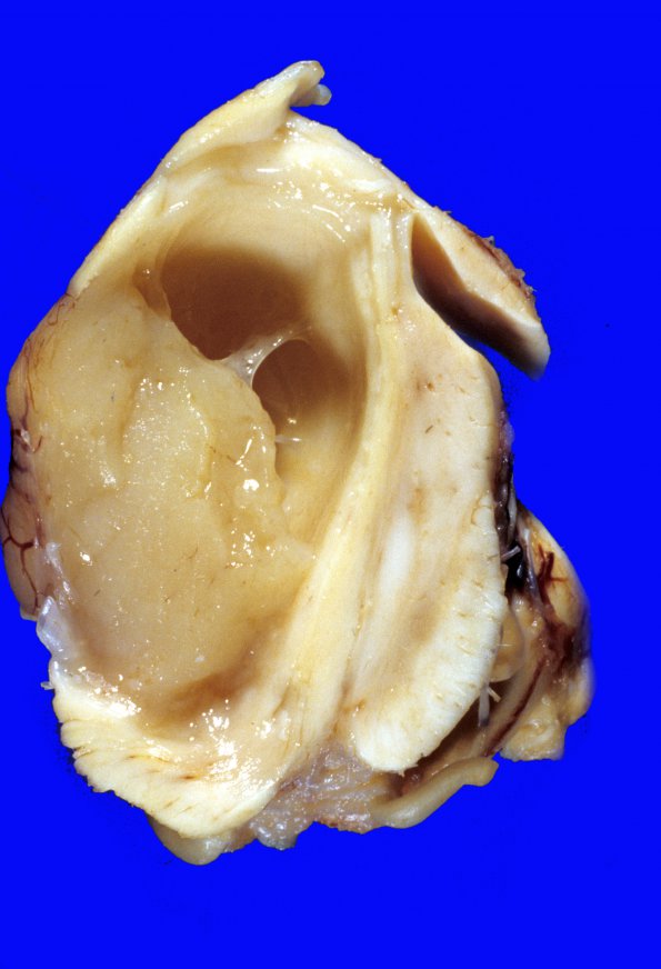 1A2 Astrocytoma, pilocytic (Case 1)  b