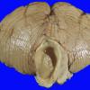 1A3 Astrocytoma, pilocytic (Case 1) f