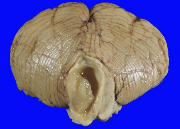 1A3 Astrocytoma, pilocytic (Case 1) f