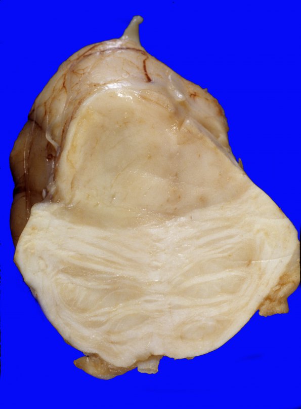 1A4 Astrocytoma, pilocytic (Case 1) 2