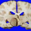 1A5 Astrocytoma, Pilocytic (Case 1) gross 3