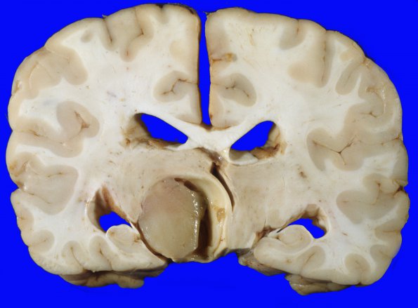 1A5 Astrocytoma, Pilocytic (Case 1) gross 3