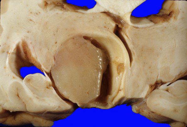 1A6 Astrocytoma, pilocytic (Case 1) g