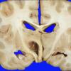 1A7 Astrocytoma, pilocytic (Case 1) 1