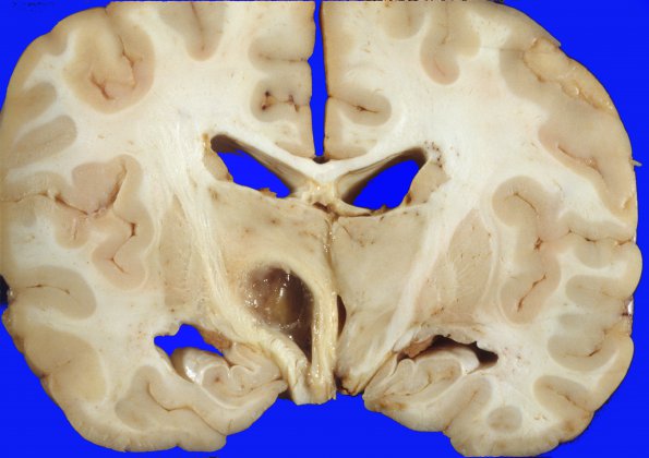 1A7 Astrocytoma, pilocytic (Case 1) 1