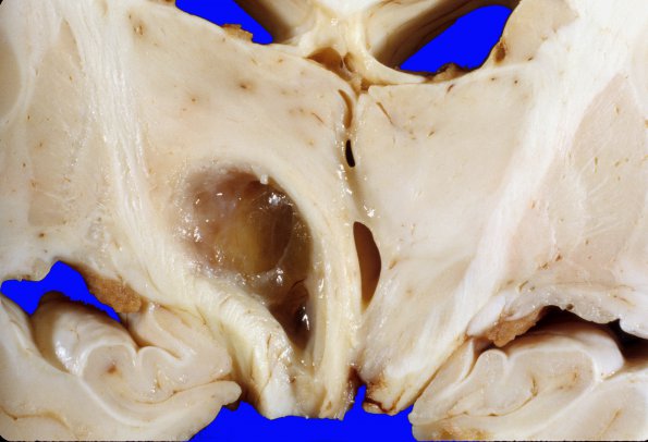 1A8 Astrocytoma, pilocytic (Case 1)  c