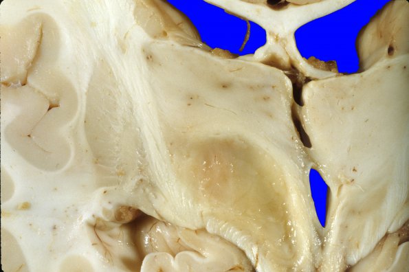 1A9 Astrocytoma, pilocytic (Case 1) j