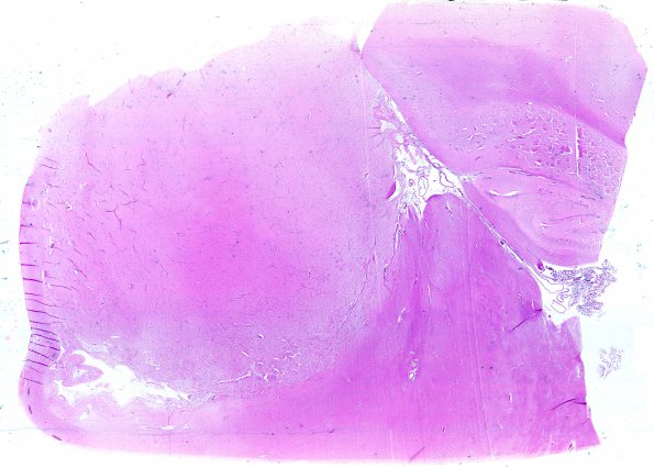 1B1 Astrocytoma, pilocytic (Case 1) WM