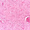 1B2 Astrocytoma, pilocytic (Case 1) 20X 2