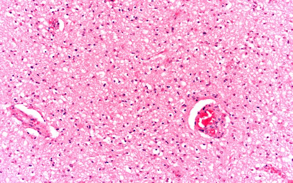 1B2 Astrocytoma, pilocytic (Case 1) 20X 2