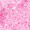 1B3 Astrocytoma, pilocytic (Case 1) 20X 3