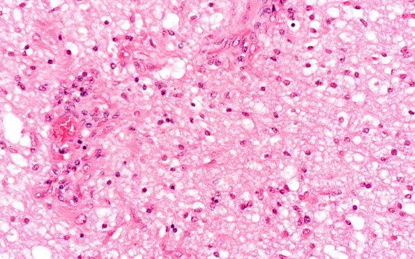 1B3 Astrocytoma, pilocytic (Case 1) 20X 3