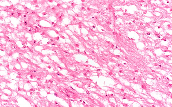 1B4 Astrocytoma, pilocytic (Case 1) 40X 2