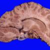 2A1 Astrocytoma, pilocytic (Case 2) A1