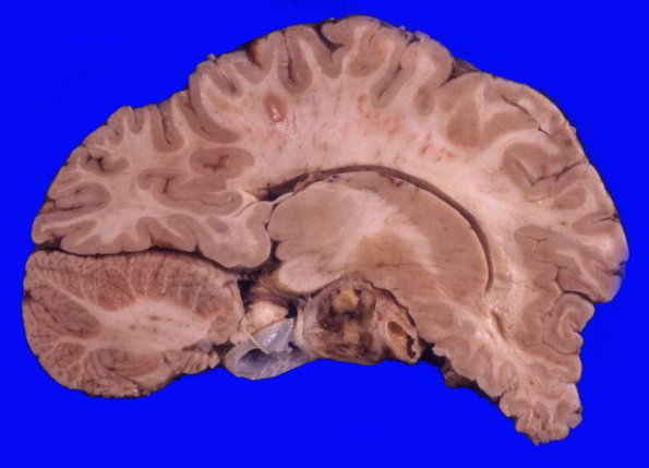 2A1 Astrocytoma, pilocytic (Case 2) A1