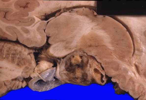 2A2 Astrocytoma, pilocytic (Case 2) 1