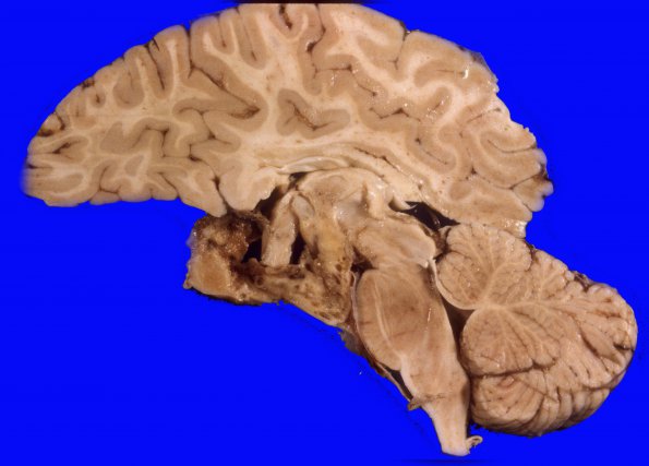 2A3 Astrocytoma, pilocytic (Case 2) A4