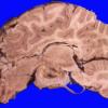 2A4 Astrocytoma, pilocytic (Case 2) A2