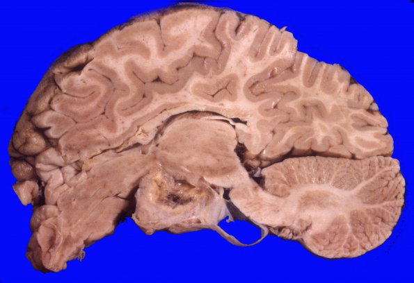 2A4 Astrocytoma, pilocytic (Case 2) A2