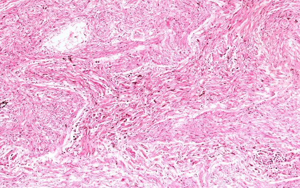 2B1 Astrocytoma, pilocytic (Case 2) N1 10X