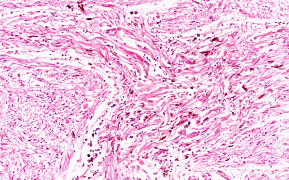 2B2 Astrocytoma, pilocytic (Case 2) N1 20X