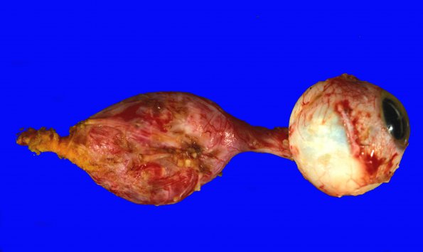 3A1 Astrocytoma, pilocytic, optic nerve (Case 3) 1A