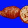 3A2 Astrocytoma, pilocytic, optic nerve (Case 3) 3A