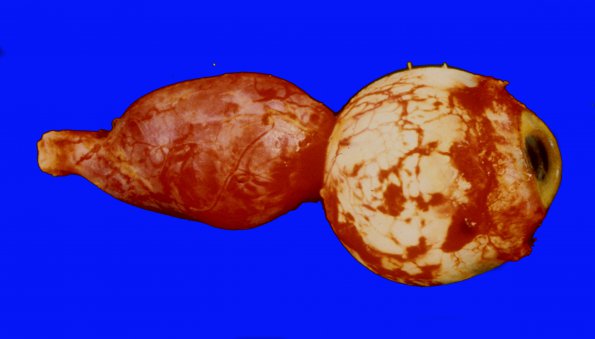 3A2 Astrocytoma, pilocytic, optic nerve (Case 3) 3A