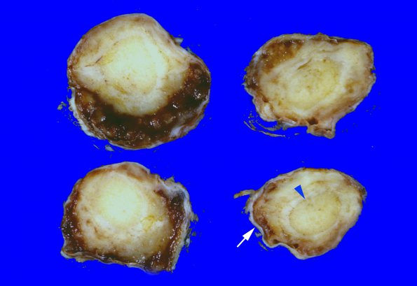 3A3 Astrocytoma, pilocytic, optic nerve (Case 3) 4 copy copy