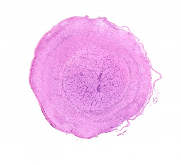 3B1 Astrocytoma, pilocytic, optic nerve (Case 3) H&E whole mount (3)