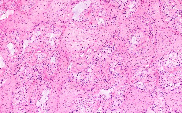 3B2 Astrocytoma, Pilocytic, Optic Nerve (Case 3) A2 H&E 10X