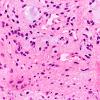 3B3 Astrocytoma, Pilocytic, Optic Nerve (Case 3) A2 H&E 40X