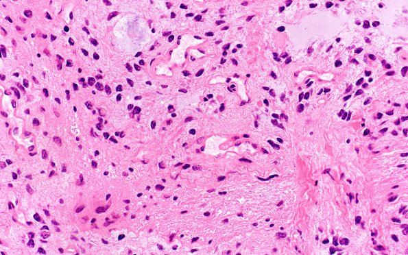 3B3 Astrocytoma, Pilocytic, Optic Nerve (Case 3) A2 H&E 40X